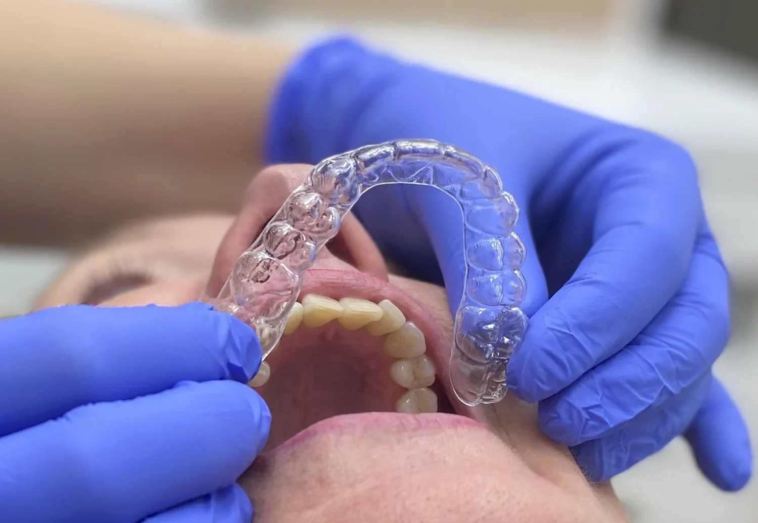 Suresmile beugel van onderkant